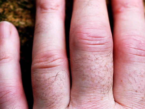 Early Signs of Arthritis: Listen to Your Body