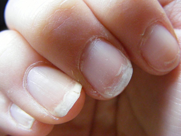 Signs that Your Fingernails are Too Dry