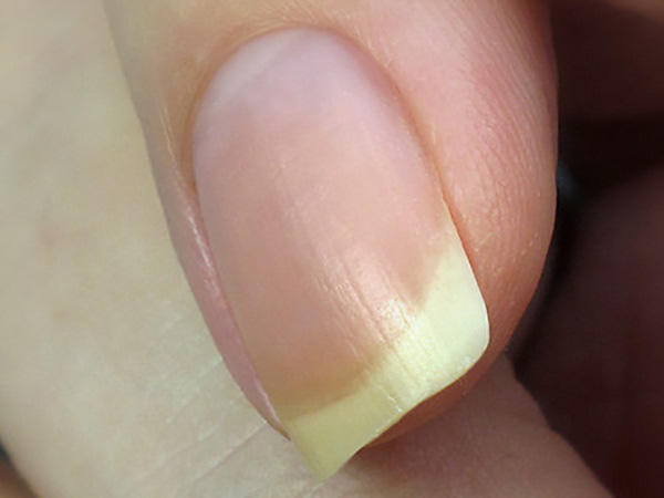 Things Your Fingernails Are Telling About Your Overall Health