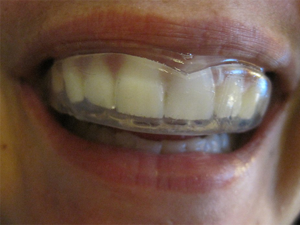 7 Essential Ways to Protect Your Teeth During Sports and Physical Activities