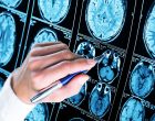 New Alzheimer's research uncovers a possible clue to the disease | health enews