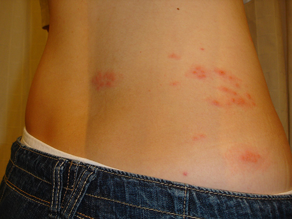 Early Signs of Shingles to Watch For