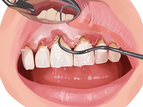 How to Prevent Plaque Buildup and Keep Your Smile Healthy