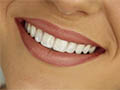 Tooth Whitening Options to Brighten Your Smile